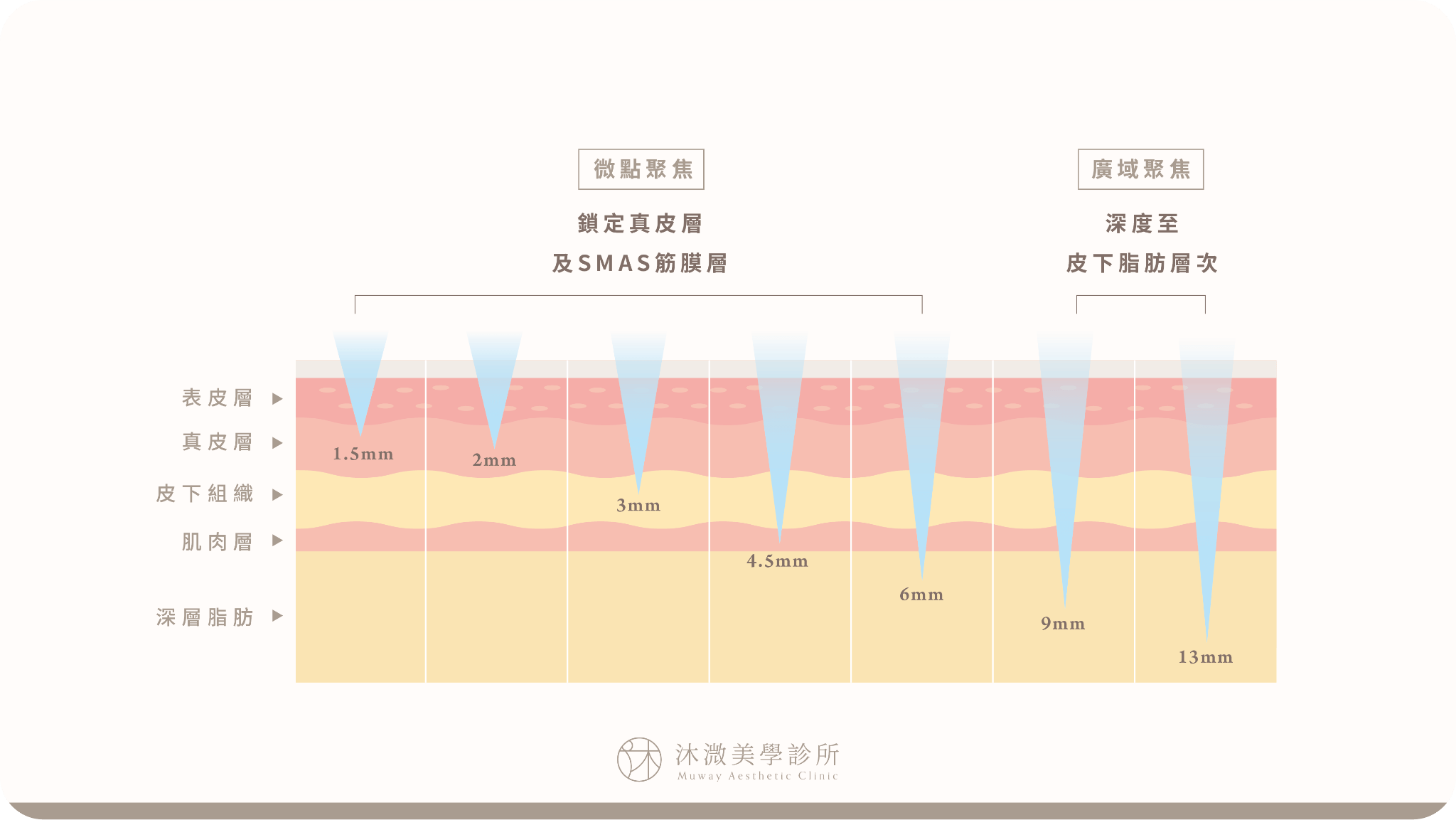 音波拉提不同探頭深度作用於真皮、皮下組織與SMAS筋膜層示意圖