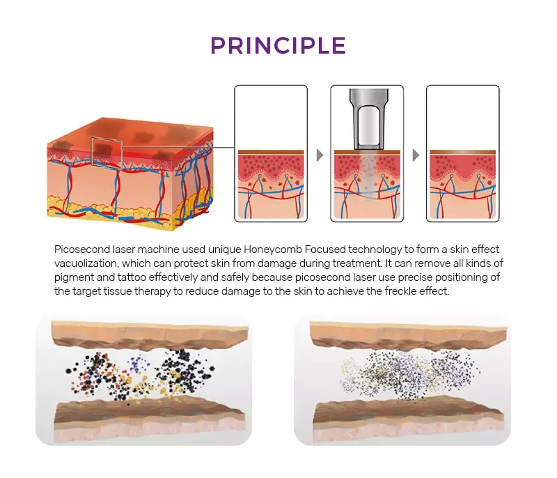 PICOCARE HEXA 聚焦透鏡及皮膚內空泡作用原理示意