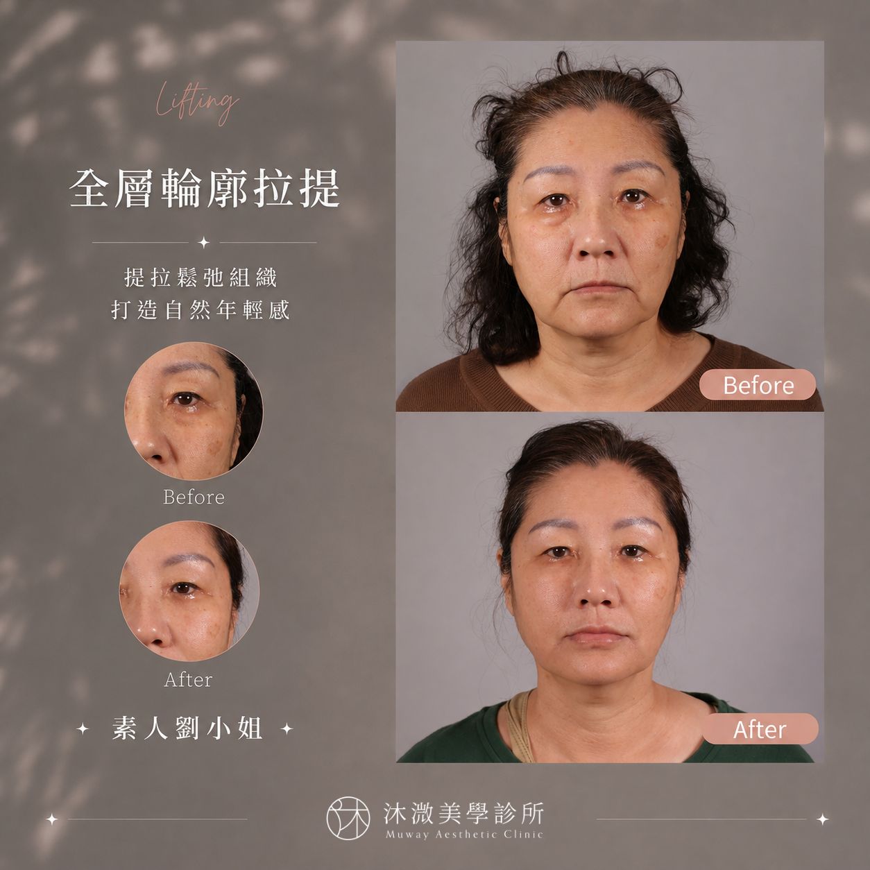 全層輪廓拉提搭配微整填充改善下臉與木偶紋案例